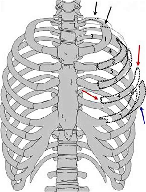 Flail chest definition, causes, symptoms, diagnosis, treatment & prognosis