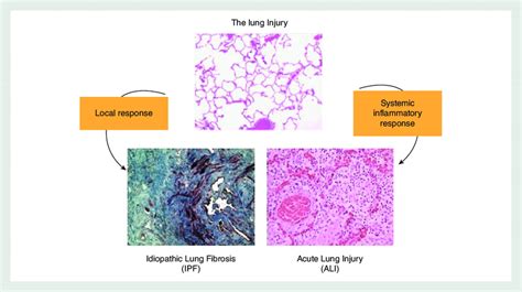 Different responses to lung injury. | Download Scientific Diagram