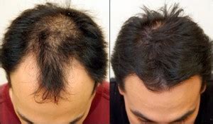 Biotin-Gold-Hair-Growth-Results-Before-After - eTopical