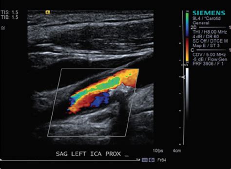 Arterial Duplex Scan Showed A Severe Internal Carotid - vrogue.co