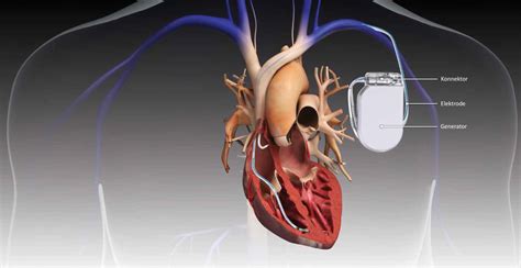 Pacemaker Essentials: Complications You Must Know - CanadiEM