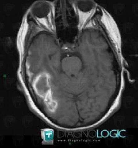 Radiology case : Contusion (CT ,MRI) - Diagnologic