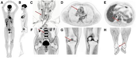 First total-body PET/CT studies show potential for better, faster, lower-dose images