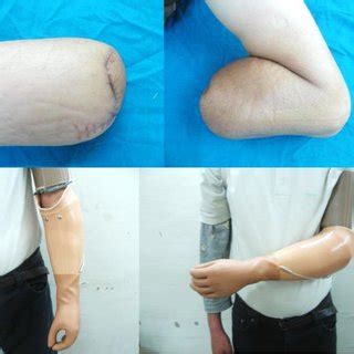 amputation of the forearm with an apparatus of the upper limb ...