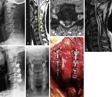 Laminectomy and Fusion | Musculoskeletal Key