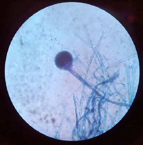 Figure 1 from Rhinocerebral mucormycosis: a rare fungal infection ...