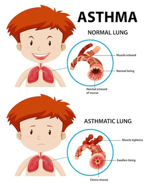 Free Vector | Asthma diagram with normal lung and asthmatic lung