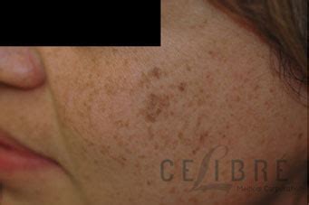 Before and After Sun Spots Removal for Age Spots - 1