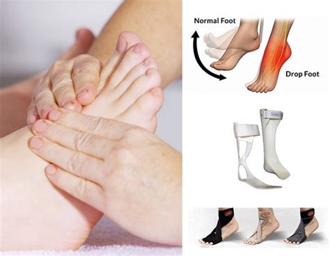 Foot Drop: Causes, Signs, Symptoms & Treatment In Malaysia