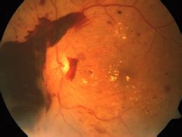 Diabetic Retinopathy Singapore|Maculopathy Causes|Treatments