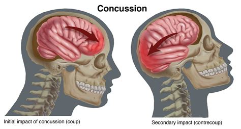 Concussion - Dr. Joshua ScottDr. Joshua Scott