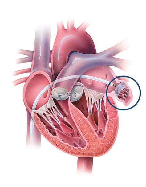 Left Atrial Appendage Closure Procedures | Johns Hopkins Medicine ...