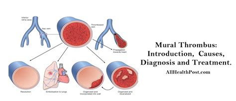 Mural Thrombus – Introduction, Causes, Diagnosis, Treatment