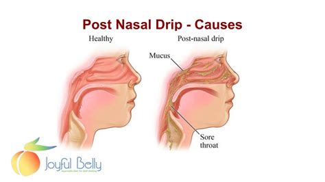 How To Cure A Post Nasal Drip - Apartmentairline8