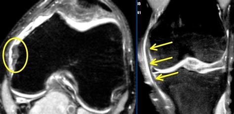 MCL Knee Injuries - Knee & Sports - Orthobullets