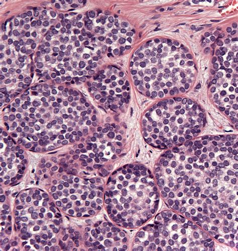 Pleomorphic lobular carcinoma in situ - Diagnostic Histopathology