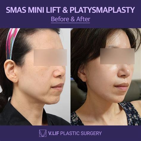 Platysmaplasty V.LIF Plastic Surgery Korea