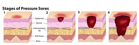 The Prevention of Pressure Ulcers | Mangar Health