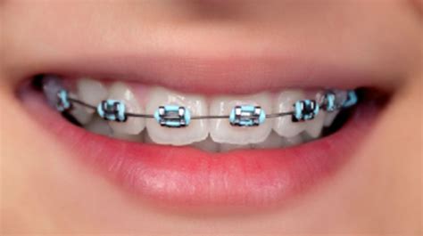 Light Blue Braces Color