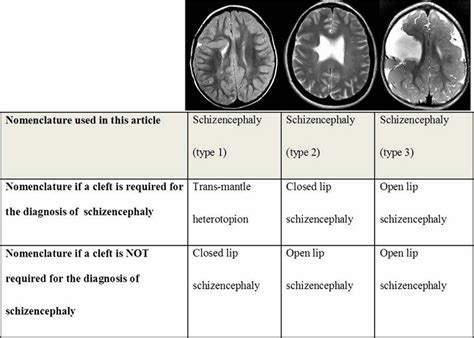 Schizencephaly causes, symptoms, diagnosis, treatment & prognosis