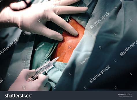 Step By Step Excision Biopsy Back Stock Photo 1517926118 | Shutterstock