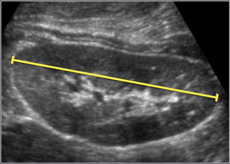 Normal Kidney Size Ultrasound