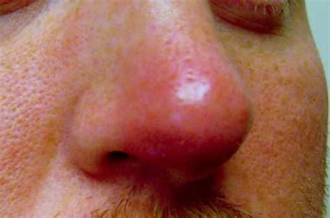 Rosacea with Acne - Causes, Treatment and Home Remedies - Treat n Heal