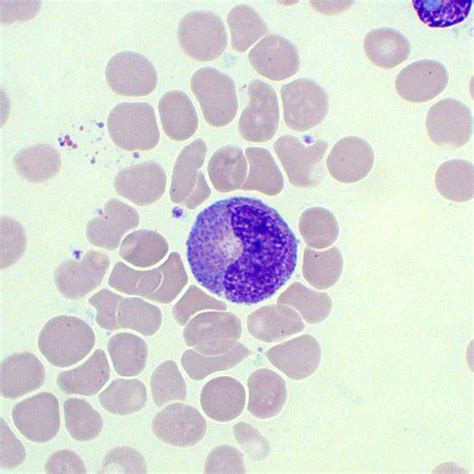 Immature Granulocytes | Blood Film - MedSchool