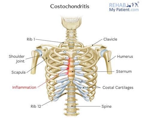 Sore Rib Cage Muscles - Mid Back And Rib Pain - This video is a ...