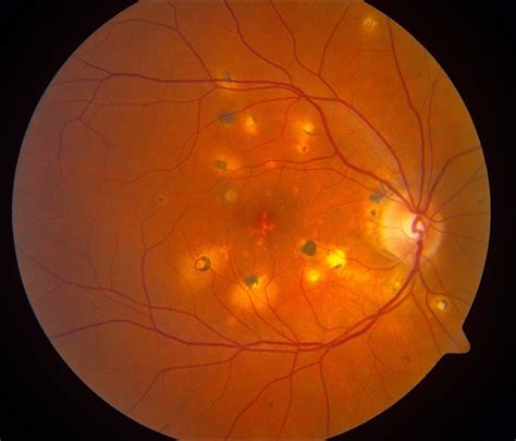 Multifocal Choroiditis - Retina Image Bank