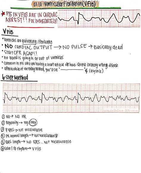 EKG V Fib Notes - NR341 - Studocu