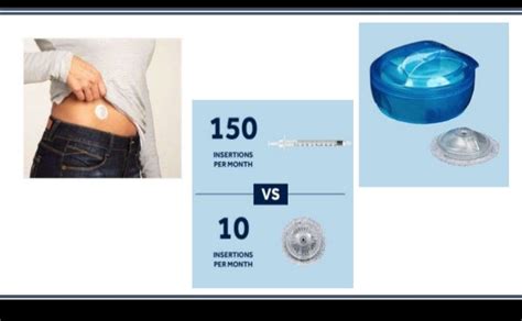 INSULIN DELIVERY METHODS : Overview on Past, Present and Future