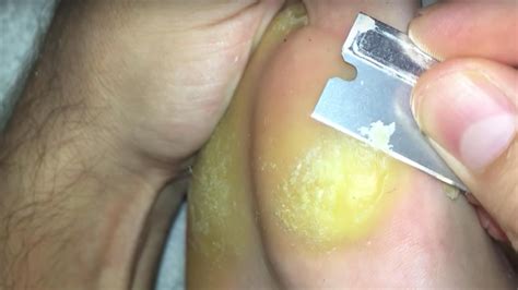 This Foot Callus Removal YouTube Channel Is Equally Disgusting and ...