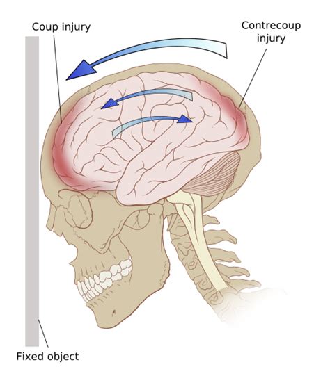 What is Concussion? - Physiopedia