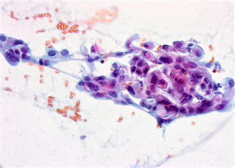 Fine needle aspiration biopsy (FNAB) | MyPathologyReport.ca