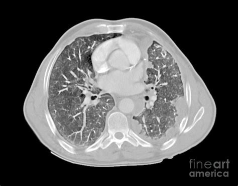 Mesothelioma Lung Cancer, Ct Scan Photograph by Du Cane Medical Imaging Ltd | Fine Art America