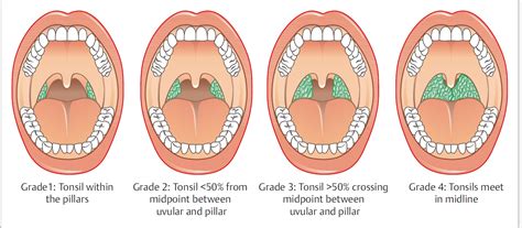 Tonsils And Adenoids Function