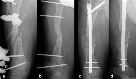 X-ray showing a non-union of a femur fracture after removal of the ...