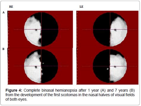 Complete Binasal Hemianopsia