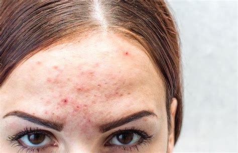 Hormonal Acne: Causes, How To Treat It, And Foods To Avoid