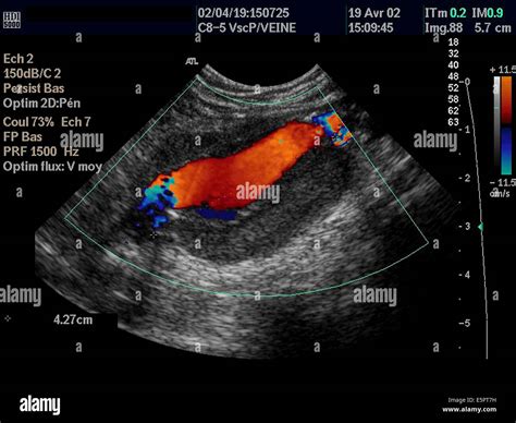 Color Doppler ultrasound scan of an aneurysm of the abdominal aorta showing circulating lumen of ...