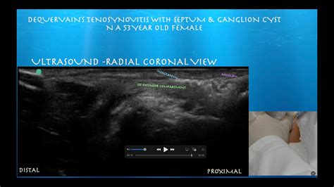 Ultrasound Guided De Quervain's Tenosynovitis Injection - YouTube