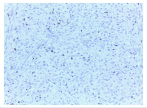 Immunohistochemistry, estrogen receptors with nuclear intensity 1. | Download Scientific Diagram