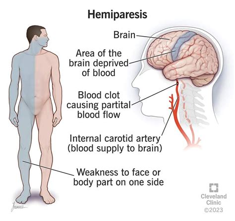 Hemiparesis: What It Is, Causes, Symptoms, Treatment & Types