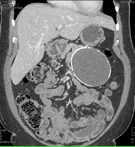 Calcified Mesenteric Cyst Involves the Pancreas / CTisus.com | Radiology imaging, Pancreas ...