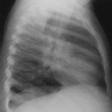 Right hilar lymph node enlargement (antero-posterior view) — adapted... | Download Scientific ...