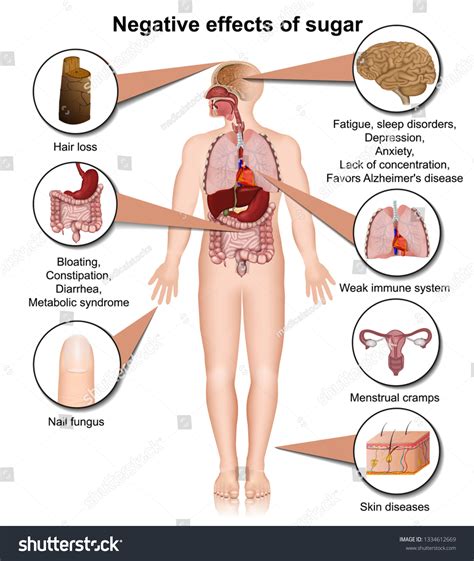 Side Effects Sugar On Human Body Stock Vector (Royalty Free) 1334612669 ...