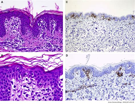 Annular Lichenoid Dermatitis of Youth: A Report of 2 Cases and a Review ...