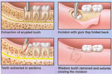 Extractions – Dentabode