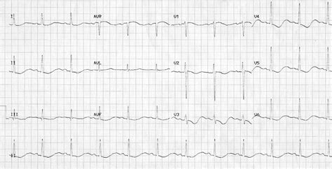 Hypokalaemia ECG changes • LITFL • ECG Library